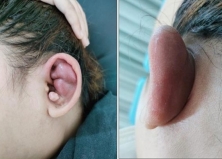 VIÊM SỤN VÀNH TAI: PHÁT HIỆN SỚM– ĐIỀU TRỊ KỊP THỜI
