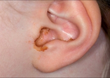 Viêm tai giữa cấp: Triệu chứng và phương pháp điều trị