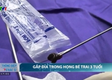 DỊ VẬT “SỐNG” – ĐỈA SUỐI KÝ SINH TRONG ĐƯỜNG THỞ TRẺ NHỎ