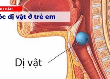 CẢNH BÁO HÓC DỊ VẬT Ở TRẺ EM