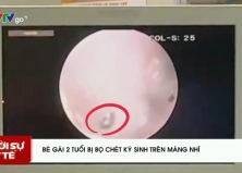 PHÁT HIỆN BỌ CHÉT KÝ SINH TRÊN MÀNG NHĨ BÉ GÁI 2 TUỔI PHÁT HIỆN BỌ CHÉT KÝ SINH TRÊN MÀNG NHĨ BÉ GÁI 2 TUỔI