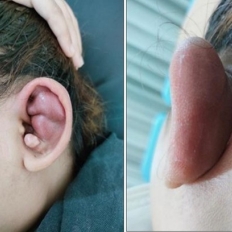 VIÊM SỤN VÀNH TAI: PHÁT HIỆN SỚM– ĐIỀU TRỊ KỊP THỜI