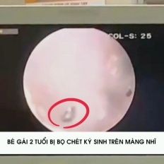 PHÁT HIỆN BỌ CHÉT KÝ SINH TRÊN MÀNG NHĨ BÉ GÁI 2 TUỔI