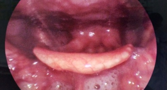 Xương cá nhọn hoắt đâm thủng hạ họng, suýt đâm ra khỏi cổ người đàn ông