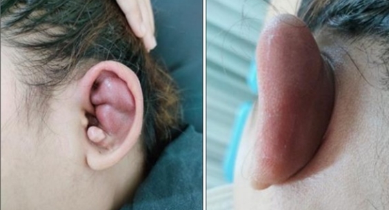 VIÊM SỤN VÀNH TAI: PHÁT HIỆN SỚM– ĐIỀU TRỊ KỊP THỜI VIÊM SỤN VÀNH TAI: PHÁT HIỆN SỚM– ĐIỀU TRỊ KỊP THỜI
