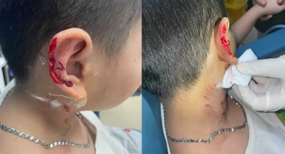 Chó cắn – Hiềm họa tiềm ẩn nguy cơ gây tử vong Chó cắn – Hiềm họa tiềm ẩn nguy cơ gây tử vong