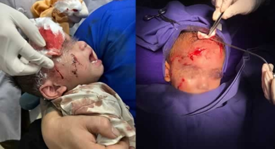 Leo trèo nghịch bình thủy tinh bị ngã, bé trai 2 tuổi bị mảnh vỡ cứa khắp mặt