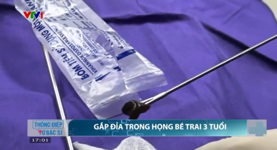 DỊ VẬT “SỐNG” – ĐỈA SUỐI KÝ SINH TRONG ĐƯỜNG THỞ TRẺ NHỎ