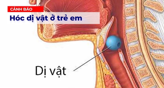 CẢNH BÁO HÓC DỊ VẬT Ở TRẺ EM