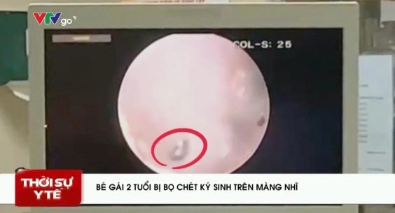 PHÁT HIỆN BỌ CHÉT KÝ SINH TRÊN MÀNG NHĨ BÉ GÁI 2 TUỔI